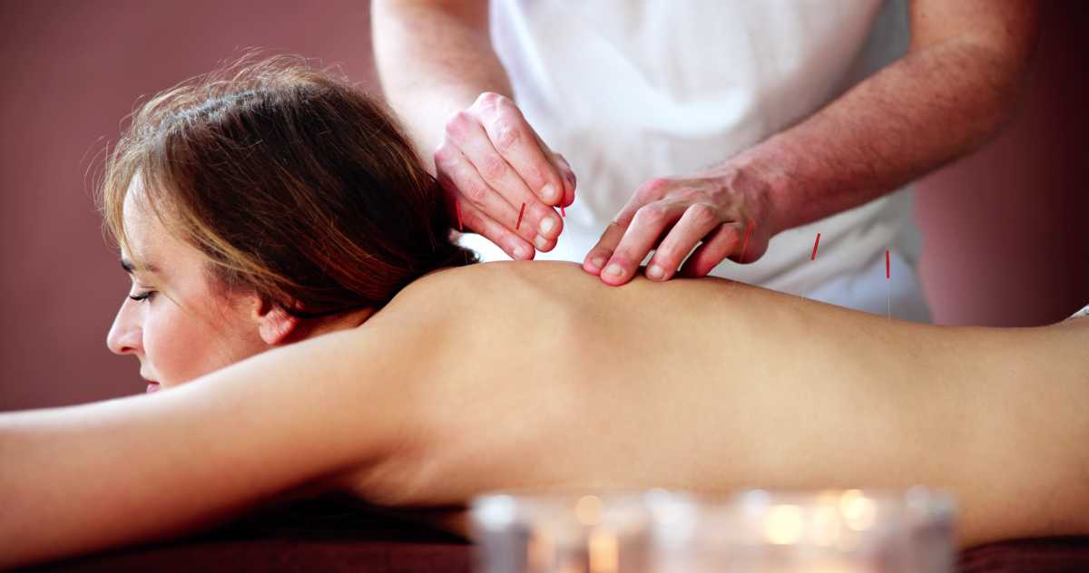 Dry Needle Acupuncture Treatment